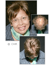 female hair restoration treatment - tupelo