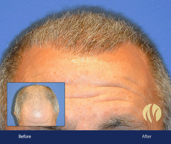 Tupelo, MS Men's Hair Replacement