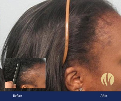 Tupelo, MS Women's Hair Transplants 2