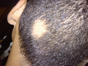 Alopecia Areata treatment, Tupelo Mississippi