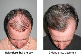 Men's Laser hair Therapy