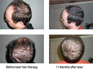 Laser treatment store for hair loss