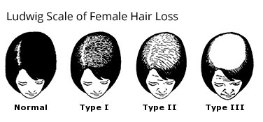 Women's hair loss classifications
