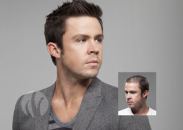 mens hair loss restoration replacement Tupelo Mississippi