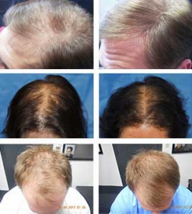 Laser Hair Loss Treatment Tupelo MS